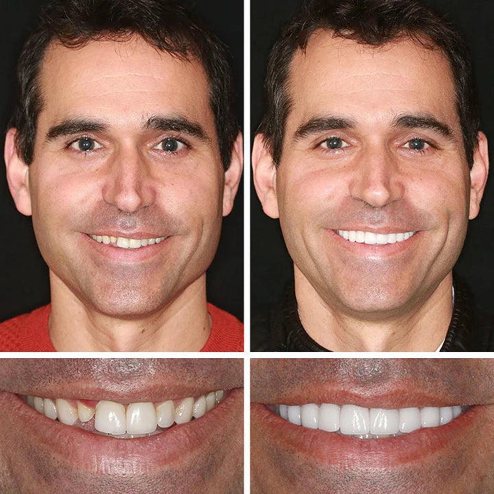 Ends Today: 70% OFF! ⏰tzeternity™ Medical Full Denture with Strong Suctiond Custom-Fit Full Functional Dentures🦷Obtain American Dental Association (ADA) Certification