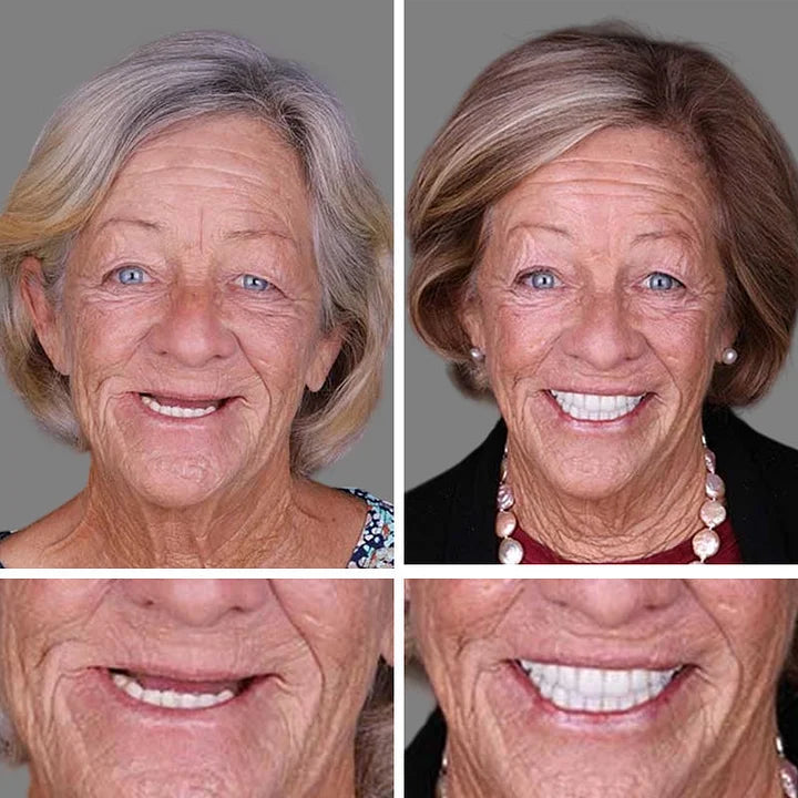 Ends Today: 70% OFF! ⏰tzeternity™ Medical Full Denture with Strong Suctiond Custom-Fit Full Functional Dentures🦷Obtain American Dental Association (ADA) Certification