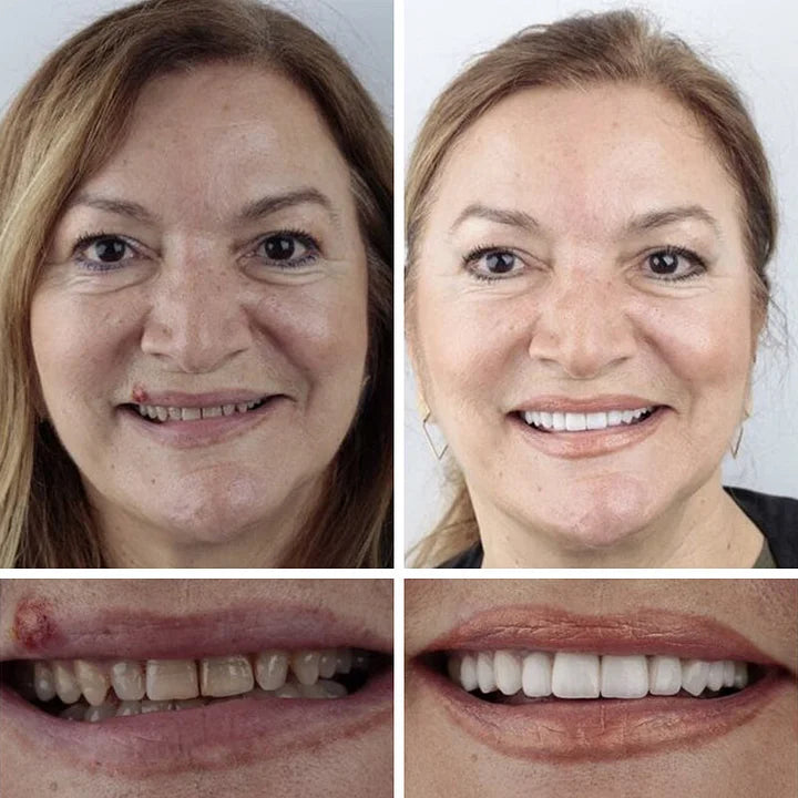 Ends Today: 70% OFF! ⏰tzeternity™ Medical Full Denture with Strong Suctiond Custom-Fit Full Functional Dentures🦷Obtain American Dental Association (ADA) Certification