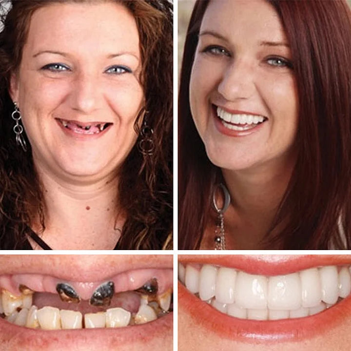 🌎Ends Today: 70% OFF! ⏰Annranic™ Medical Full Denture with Strong Suctiond🦷Obtain American Dental Association (ADA) Certification