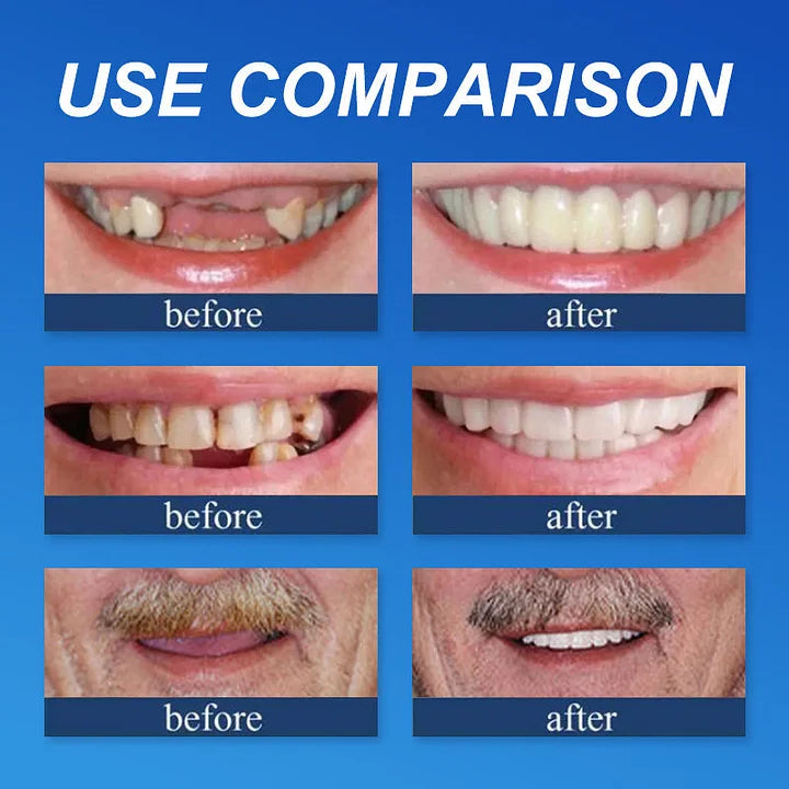 Ends Today: 70% OFF! ⏰tzeternity™ Medical Full Denture with Strong Suctiond Custom-Fit Full Functional Dentures🦷Obtain American Dental Association (ADA) Certification